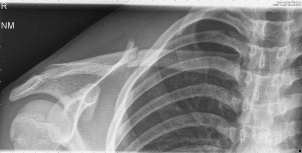 Broken collarbone