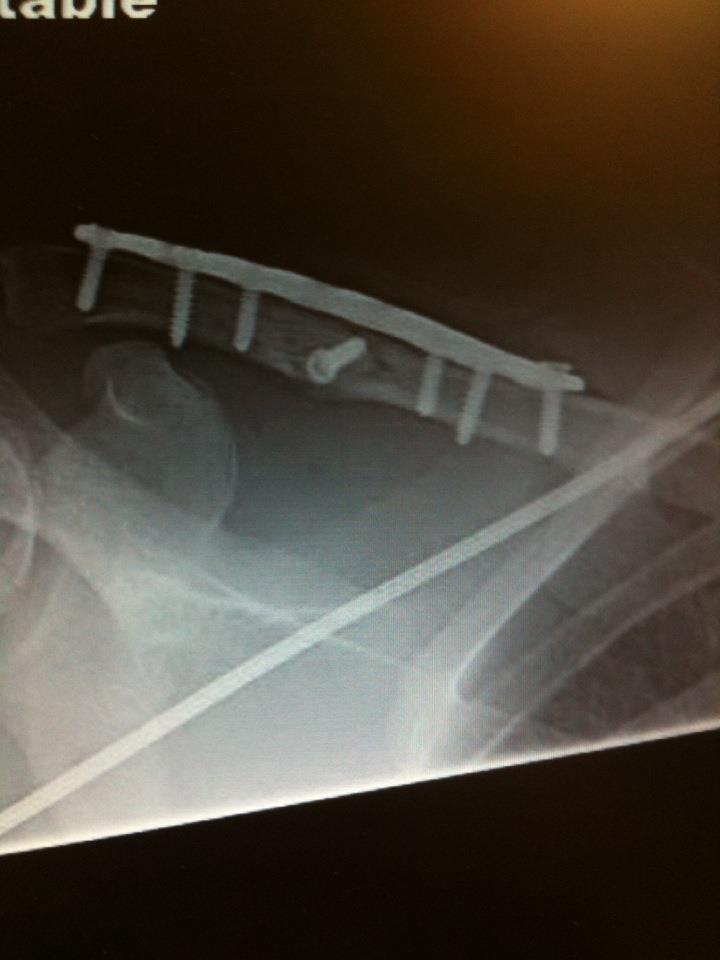 Broken Collarbone