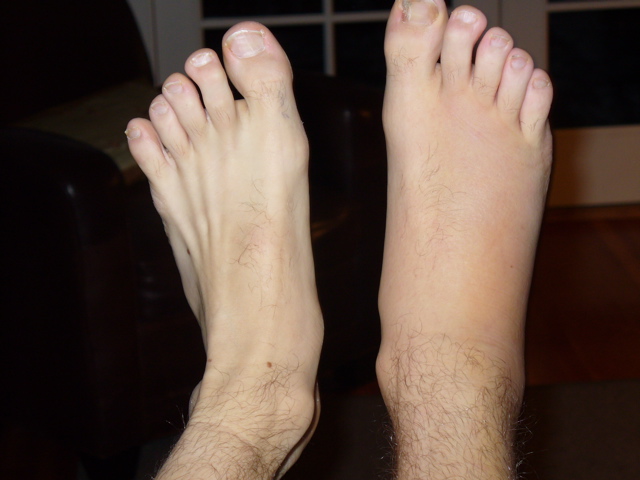 Broken fibula Vs. normal