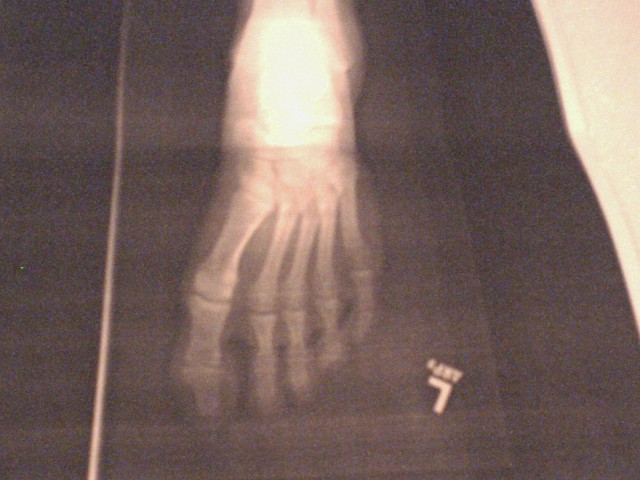 Broken foot