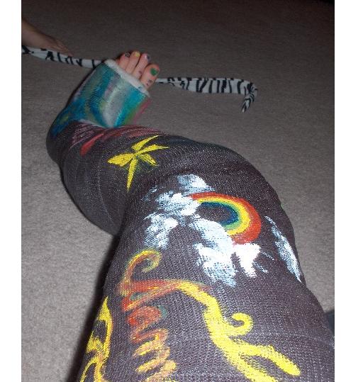 broken leg