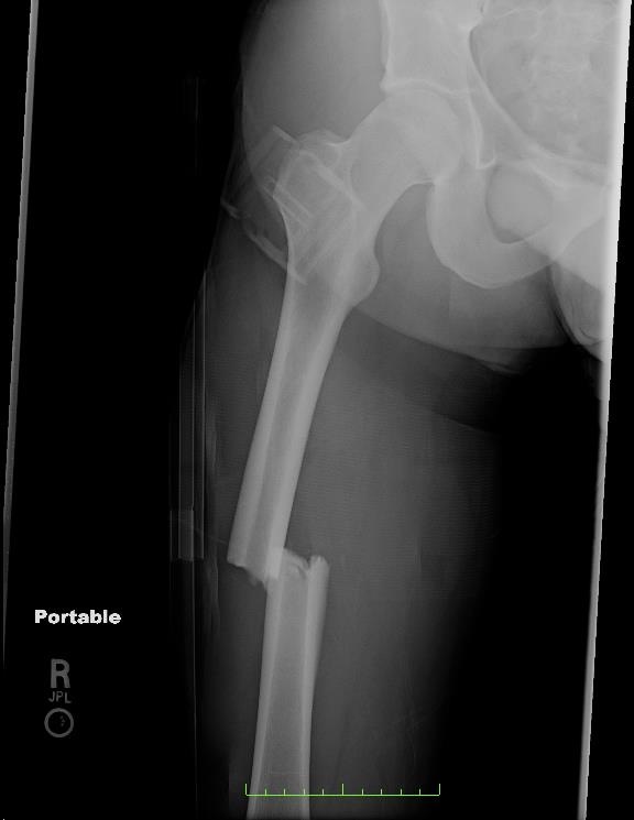 Broken Right Femur
