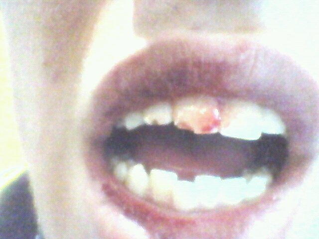 Broken Teeth