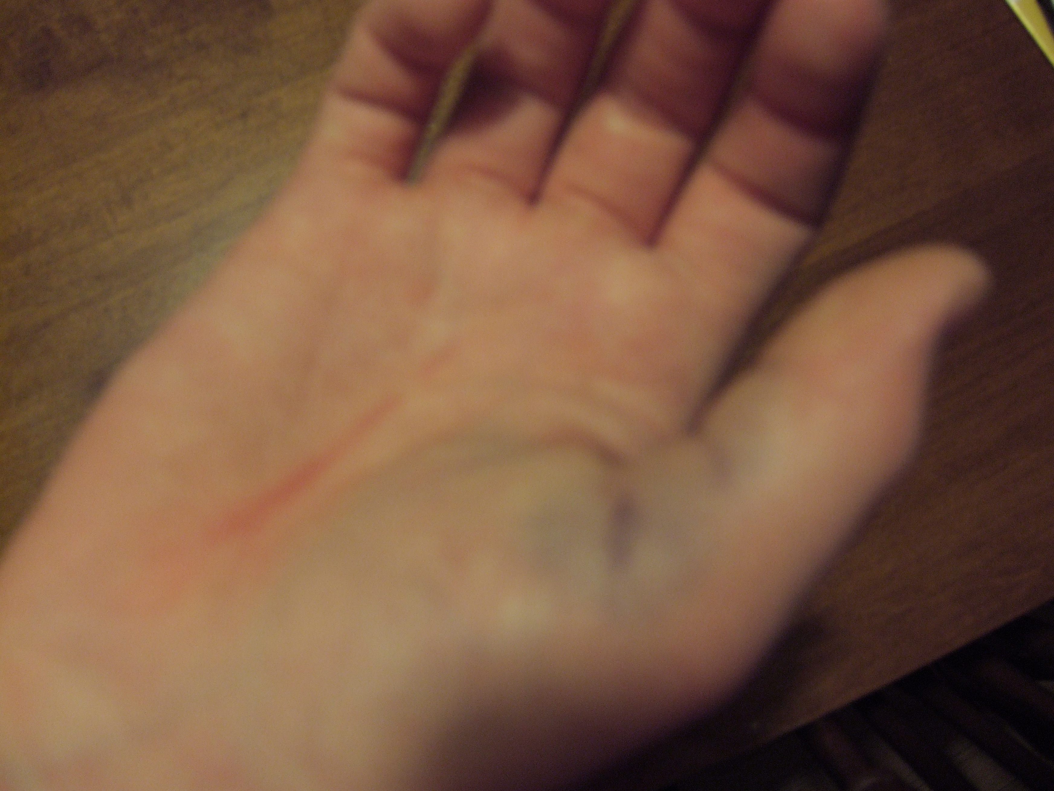 Broken Thumb From Bromley