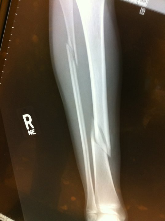 Broken tibia and you see one of the places i fractured my fibula