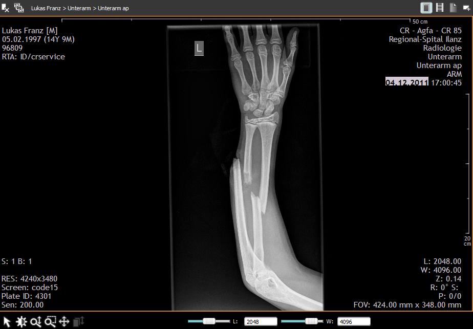 Broken Ulna & Radius 