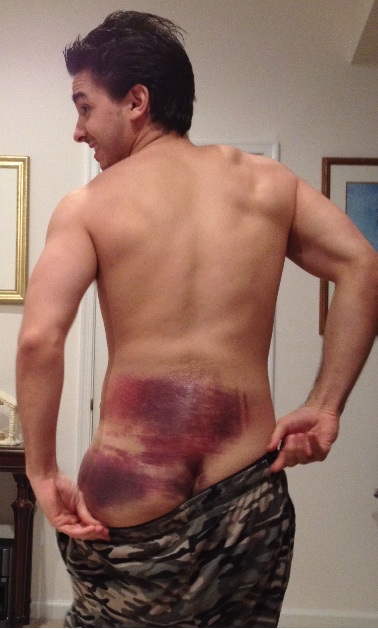 Bruise