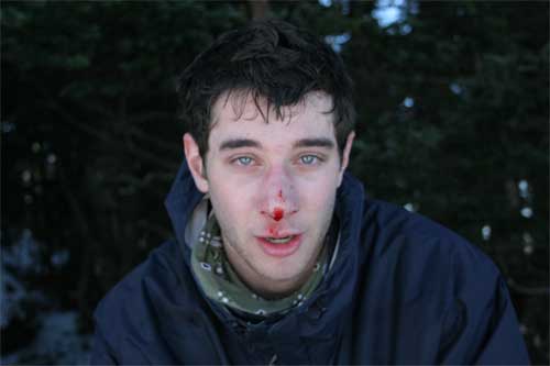 busted nose after slamming on some ice.