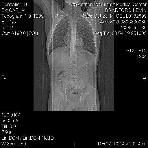 CAT Scan