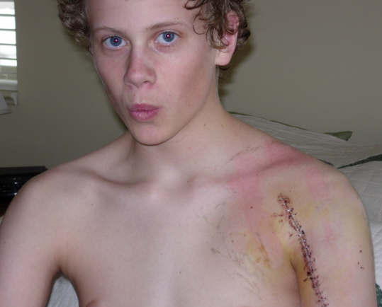 Colin broke his arm...a couple of times