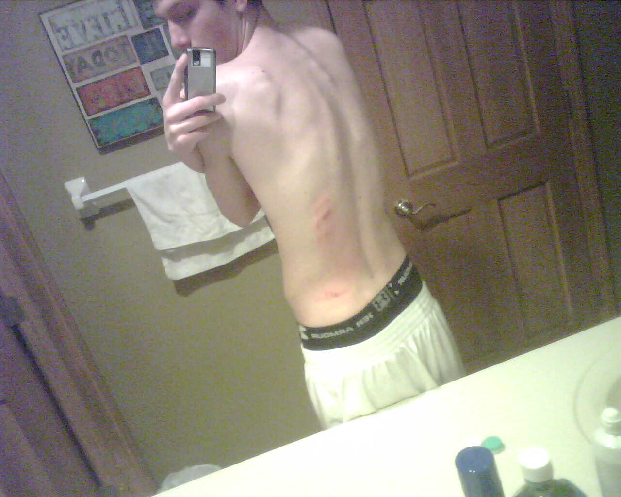 Cut up back on ice and concussion