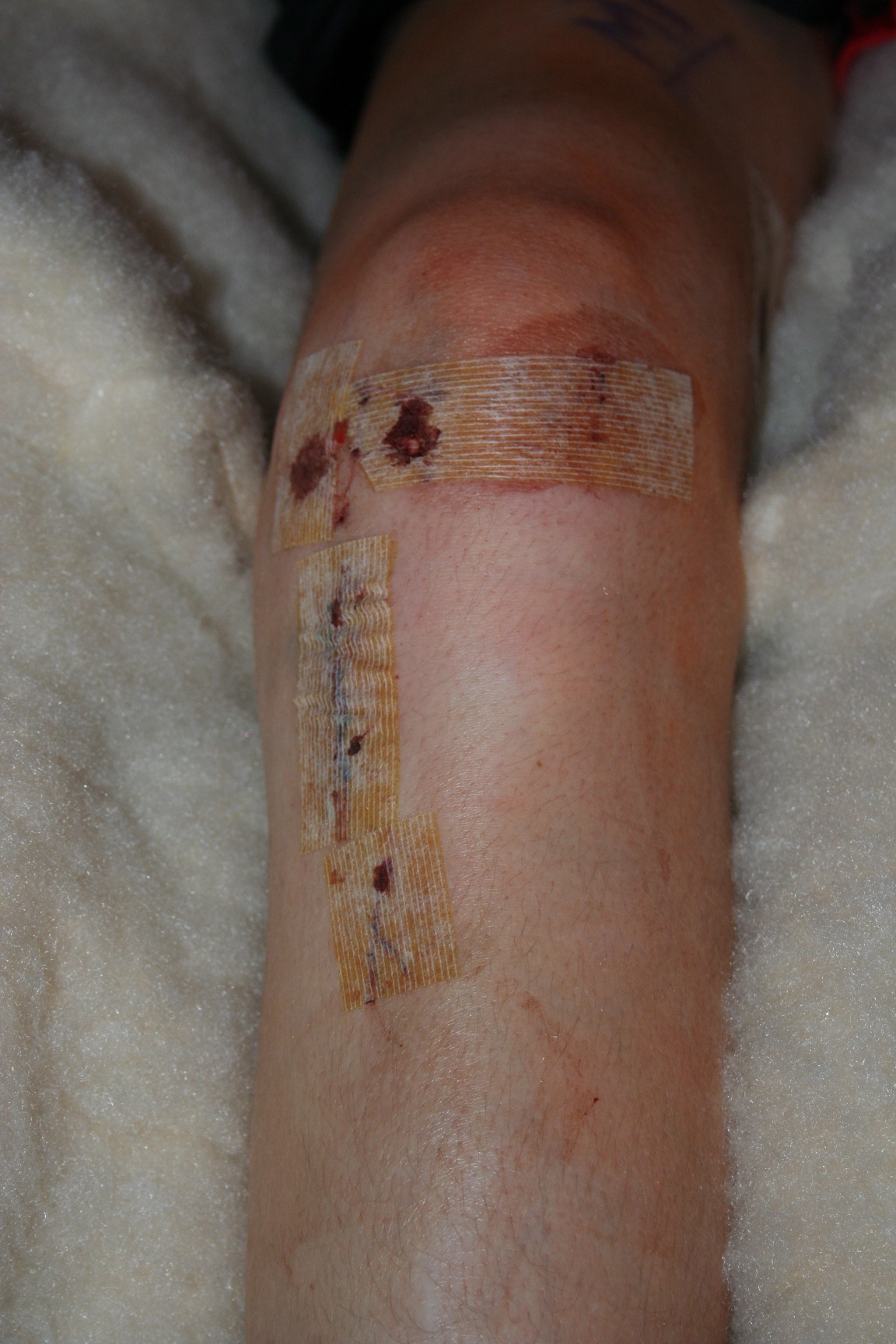 Day after reconstructive knee surgery