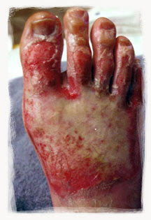 Dirty Matt Brogan's foot after he got his cast off!!!!