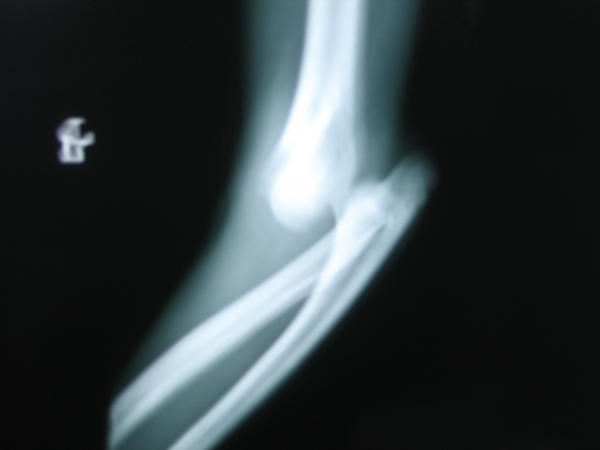 dislocated elbow x ray
