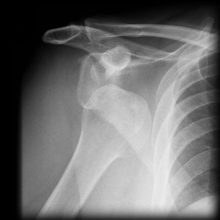 Dislocated Shoulder