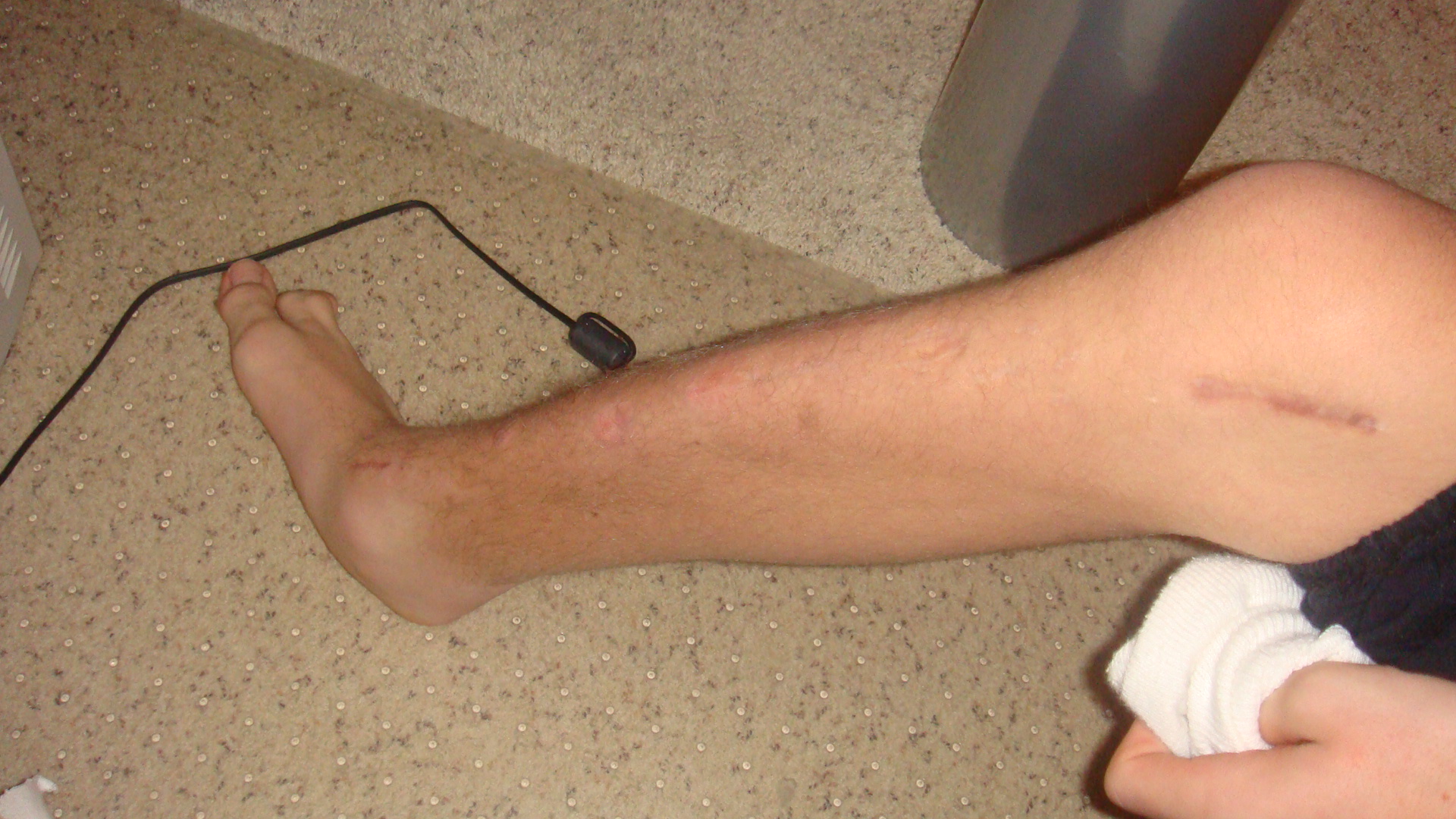 Drop off,  to flat. injury