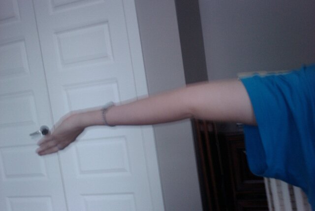 Ehlersdanlos syndrom