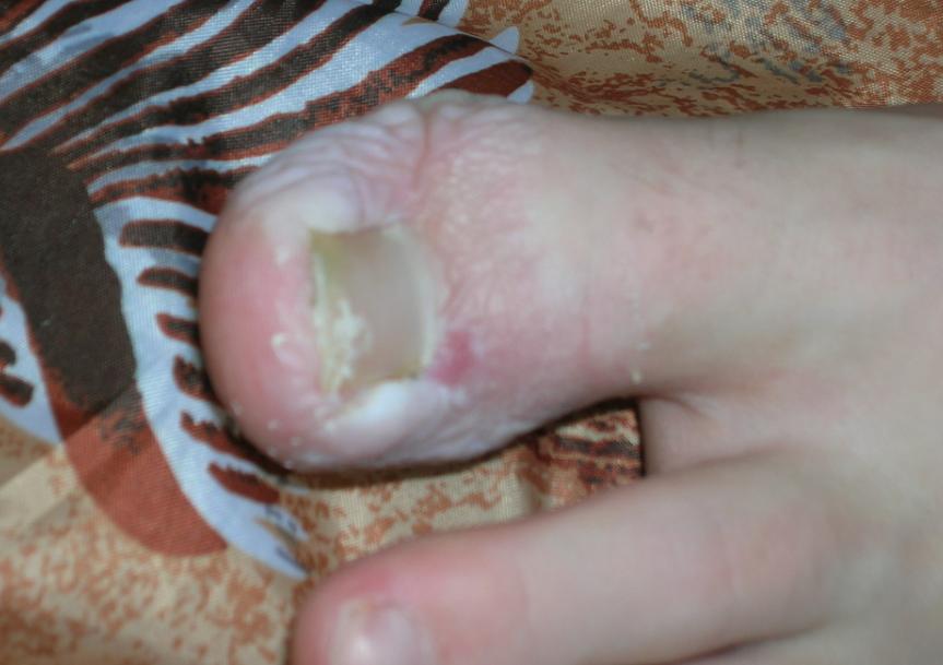 eldub's toe