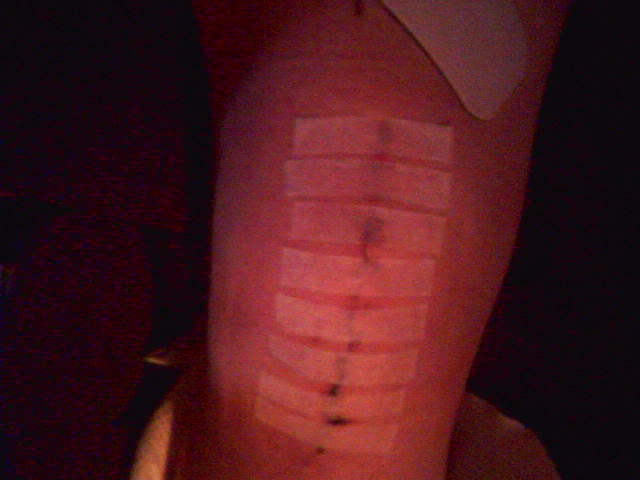 ew shattered kneecap.