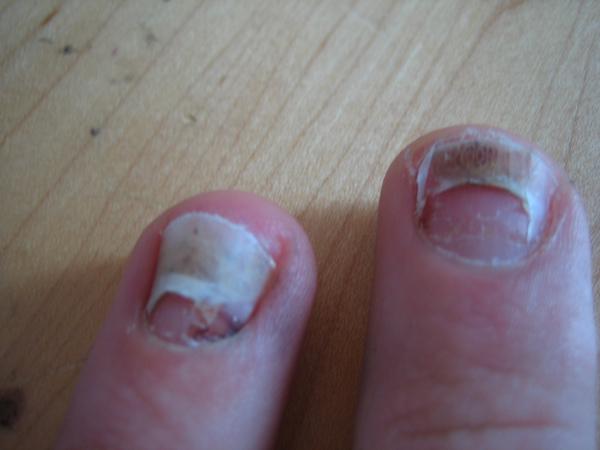 Finger nails falling off