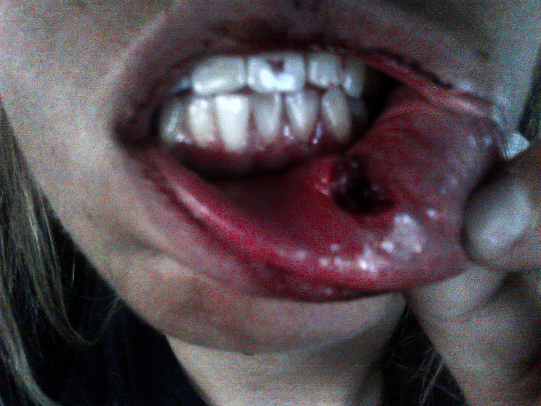 Forgot to put the mouthguard in.