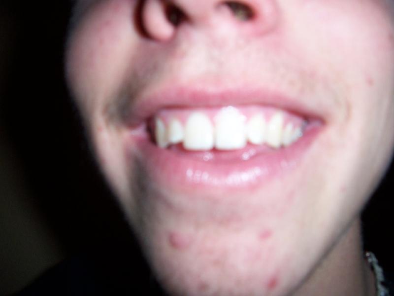 Friends makin fun of my teeth, see i dont care!