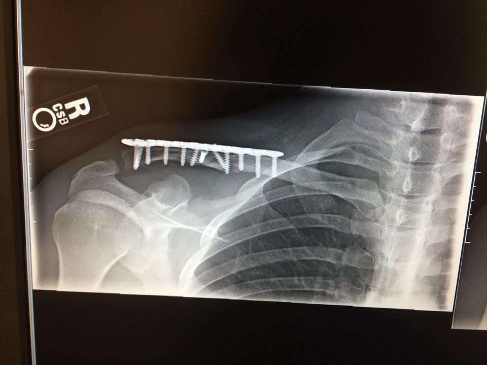 Henrik Harlaut collarbone 