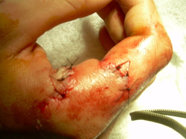 I got sliced breaking up a soon to be fight