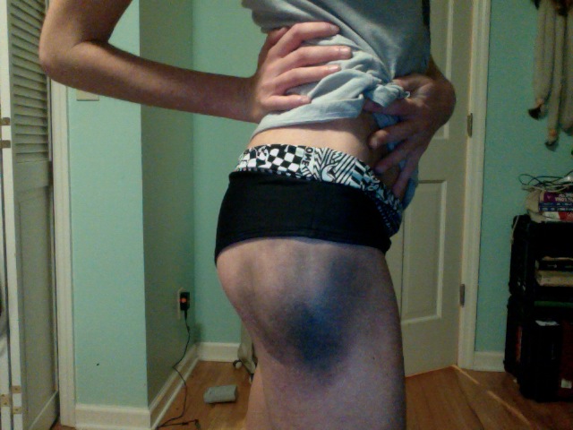 I love getting good bruises from skiing :-)