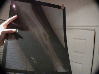 it's my broken leg from 2002 season