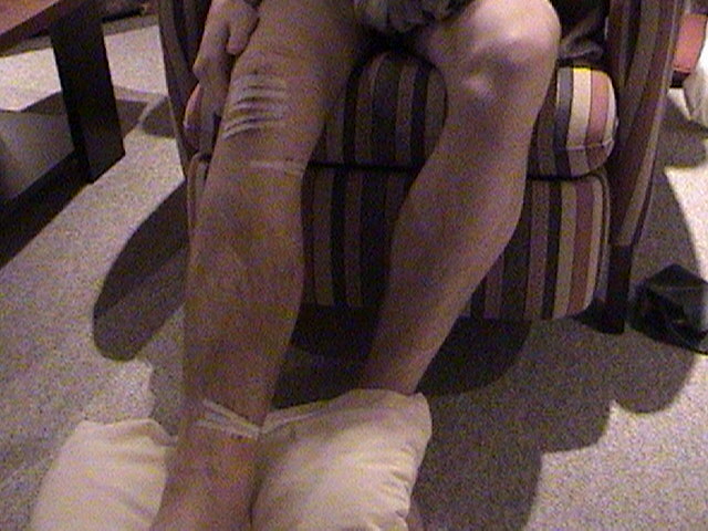 its my brother after his leg operation... we can see where they introduced the metal bar in his tibi
