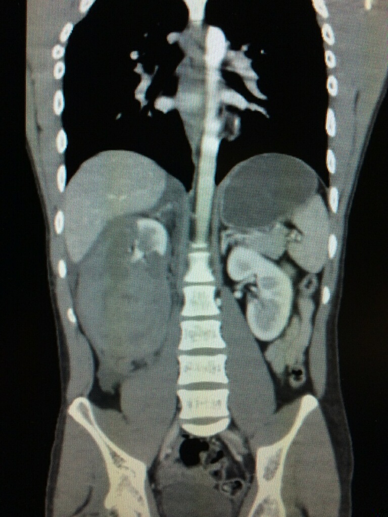 kidney tear