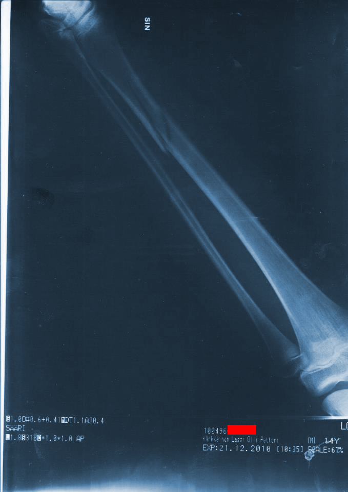 Last season shin x-ray