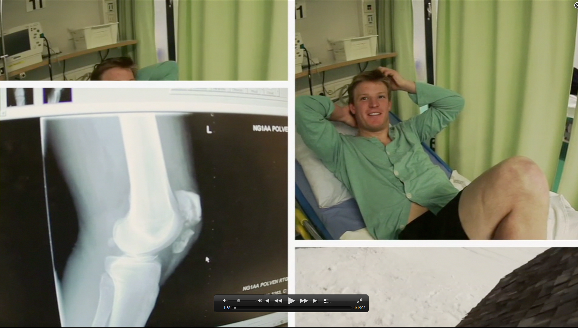 LJ's Knee Xray Pre-Surgery