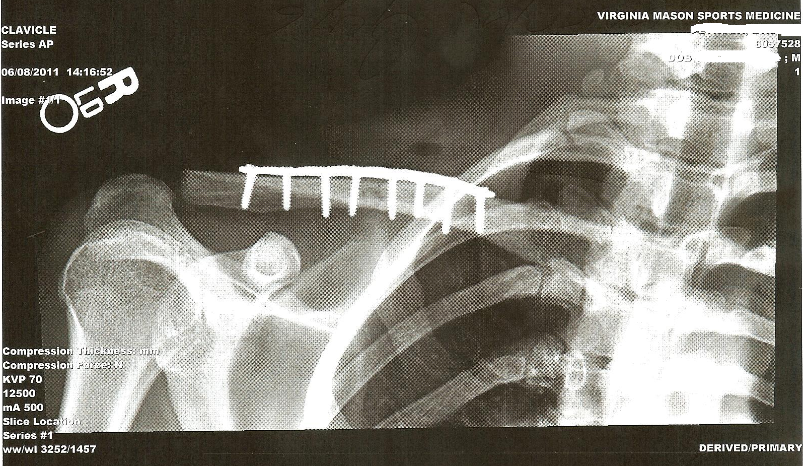 Locking Midshaft Clavicular Plate