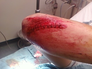 Long boarding crash