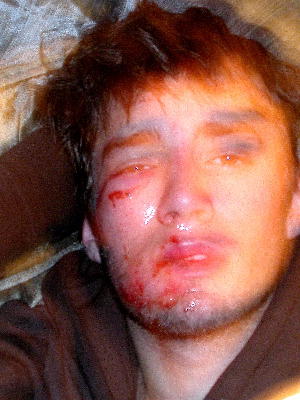 Me after coming up a little short on a back flip and breaking my cheak bone