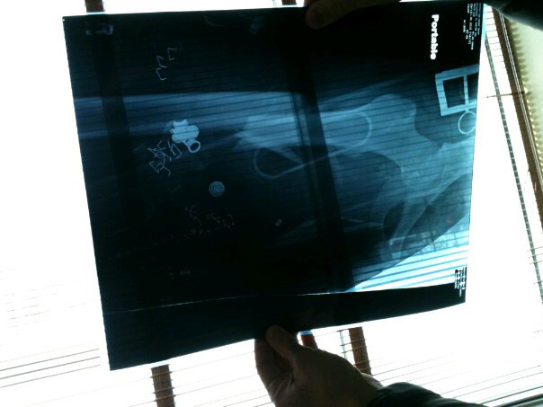 My broken femur