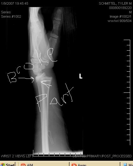 My broken wrist