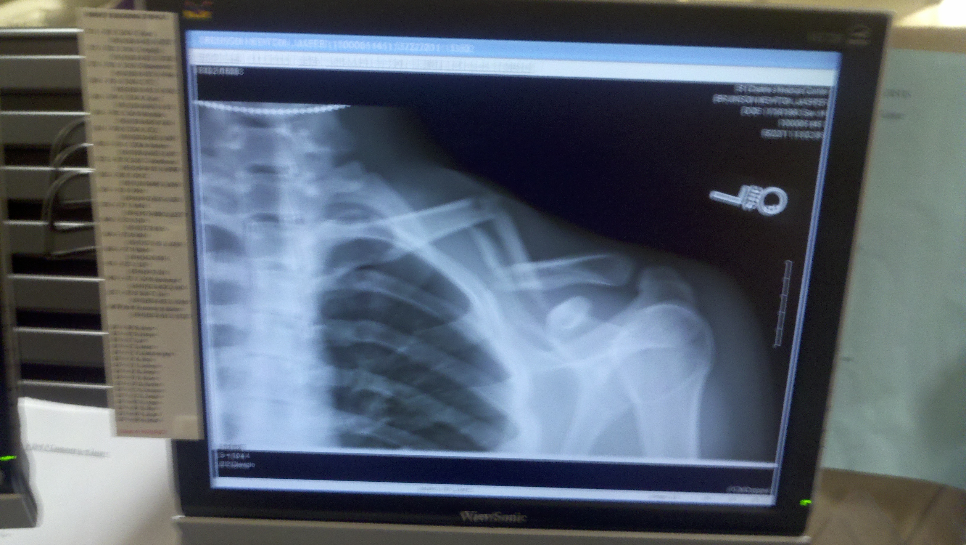 My collar bone in 4 pieces.