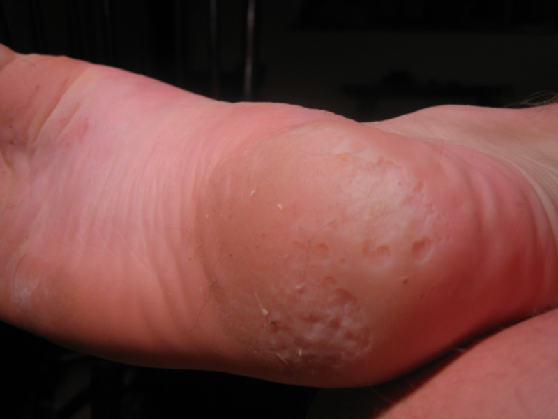 my foot is lookin kinda gnarly