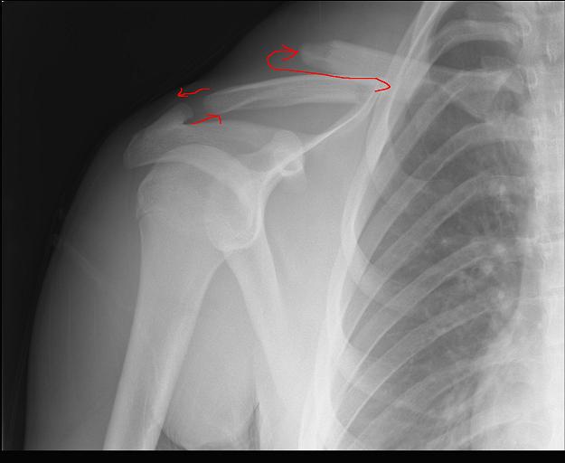 My free floating collar bone