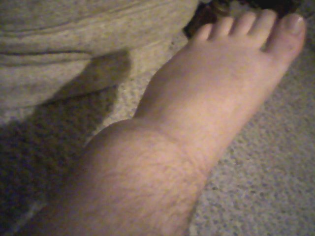 My fucked up ankle