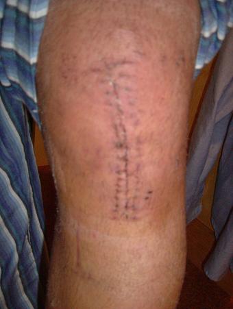 My fucking leg!That's freestyle stuff too!haha...I crashed in the snowpark of Tignes.I was operated