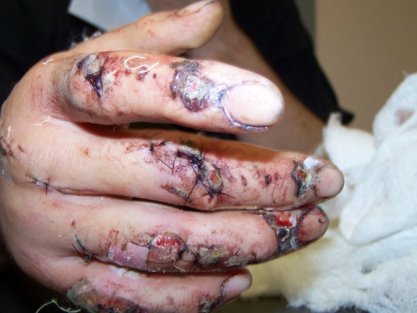 My hand one week after accident