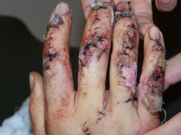 My knuckles and torn tendons