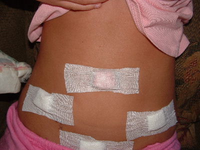 my stitched up stomach