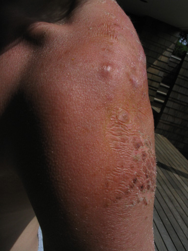 my sunburned rugburn