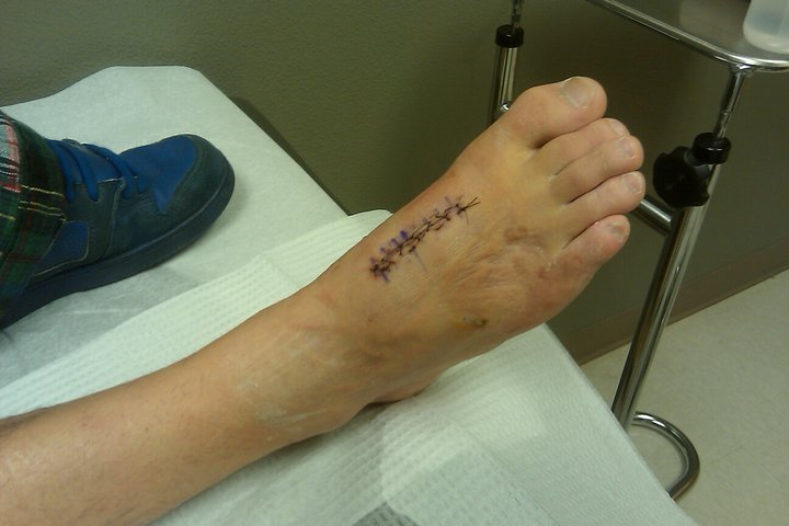 Outside of my broken foot