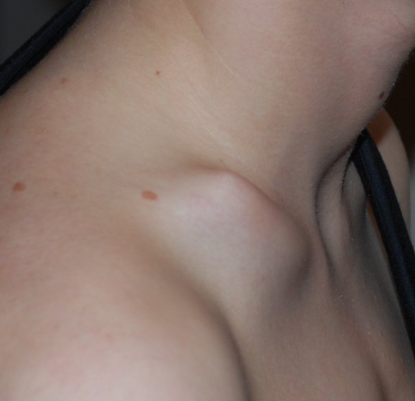 Pre Surgury Collarbone